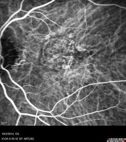 Non-exudative wet AMD right eye (treatment naive quiescent)
82 year old man.  ICG shows CNVM in the right eye.  This stayed quiet for 3 years and then started leaking and responded well to Avastin.
