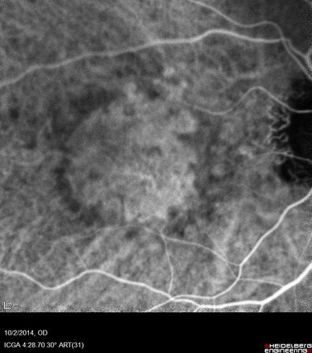 Non-exudative wet AMD right eye (treatment naive quiescent)
82 year old man.  ICG shows CNVM in the right eye.  This stayed quiet for 3 years and then started leaking and responded well to Avastin.
