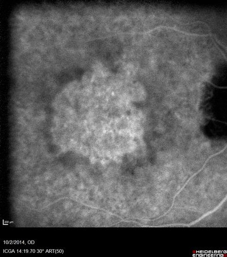 Non-exudative wet AMD right eye (treatment naive quiescent)
82 year old man.  ICG shows CNVM in the right eye.  This stayed quiet for 3 years and then started leaking and responded well to Avastin.
