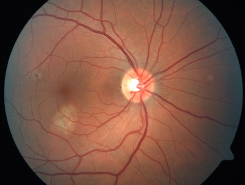 Choroidal Neovascular Membrane - Multifocal Scars - PIC vs MFC vs OHS 
