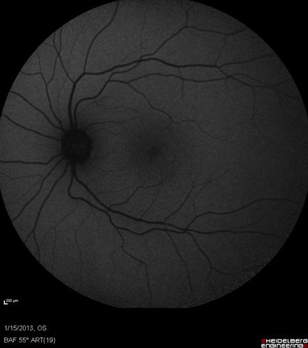 Choroidal Neovascular Membrane - Multifocal Scars - PIC vs MFC vs OHS 
