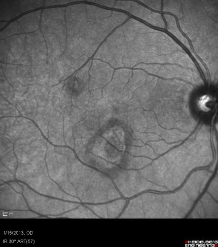 Choroidal Neovascular Membrane - Multifocal Scars - PIC vs MFC vs OHS 
