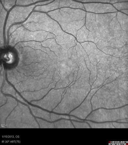 Choroidal Neovascular Membrane - Multifocal Scars - PIC vs MFC vs OHS 
