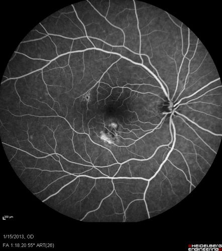 Choroidal Neovascular Membrane - Multifocal Scars - PIC vs MFC vs OHS 

