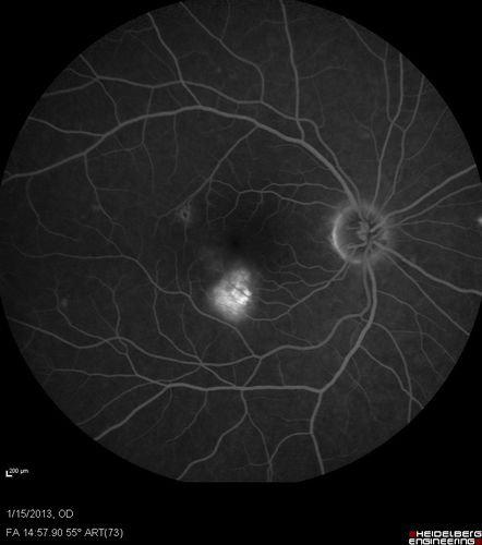 Choroidal Neovascular Membrane - Multifocal Scars - PIC vs MFC vs OHS 
