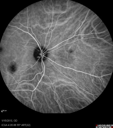 Choroidal Neovascular Membrane - Multifocal Scars - PIC vs MFC vs OHS 
