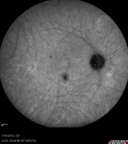 Choroidal Neovascular Membrane - Multifocal Scars - PIC vs MFC vs OHS 
