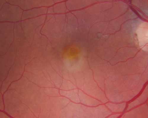 Macular Degeneration - Choroidal Laser Left eye - New Subfoveal CNVM left eye - Did well with Avastin
69-year-old woman new vision loss right eye and old macular scar left eye. OD 20/40, OS 20/200
