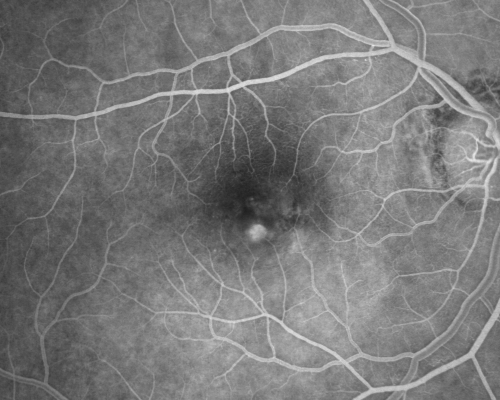 Macular Degeneration - Choroidal Laser Left eye - New Subfoveal CNVM left eye - Did well with Avastin
69-year-old woman new vision loss right eye and old macular scar left eye. OD 20/40, OS 20/200

