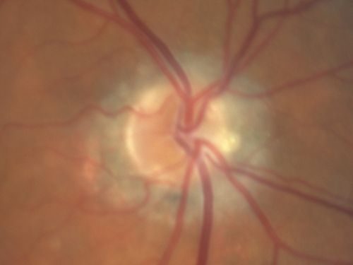 Choroidal Neovascular Membrane - Optic Disc Drusen - Hemorrhage (Coumadin) 
82-year-old man with decreased vision in the left eye over about the last six to 12 months.  He is also on Coumadin.    OD 20/20, OS 20/80
