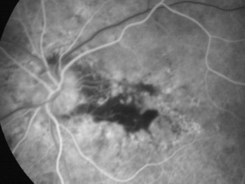 Choroidal Neovascular Membrane - Optic Disc Drusen - Hemorrhage (Coumadin) 
82-year-old man with decreased vision in the left eye over about the last six to 12 months.  He is also on Coumadin.    OD 20/20, OS 20/80
