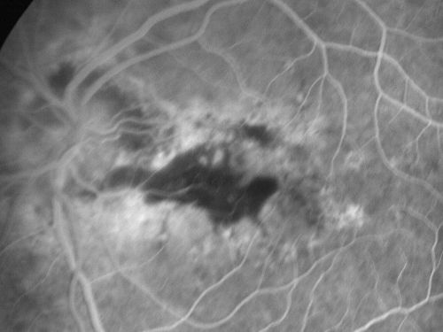 Choroidal Neovascular Membrane - Optic Disc Drusen - Hemorrhage (Coumadin) 
82-year-old man with decreased vision in the left eye over about the last six to 12 months.  He is also on Coumadin.    OD 20/20, OS 20/80
