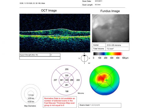 Choroidal Neovascular Membrane - Optic Disc Drusen - Hemorrhage (Coumadin) 
82-year-old man with decreased vision in the left eye over about the last six to 12 months.  He is also on Coumadin.    OD 20/20, OS 20/80
