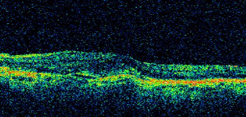 Choroidal Neovascular Membrane - Optic Disc Drusen - Hemorrhage (Coumadin) 
82-year-old man with decreased vision in the left eye over about the last six to 12 months.  He is also on Coumadin.    OD 20/20, OS 20/80
