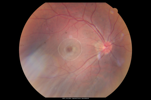 Macular Hemorrahge and Probable CNVM Right eye for 2 weeks VA 20/400 - 20 Year old
20-year-old man noticed vision loss in the right eye about two weeks ago and if anything it seems to be getting worse. He is a high myope.  VISUAL ACUITY:  OD 20/400
