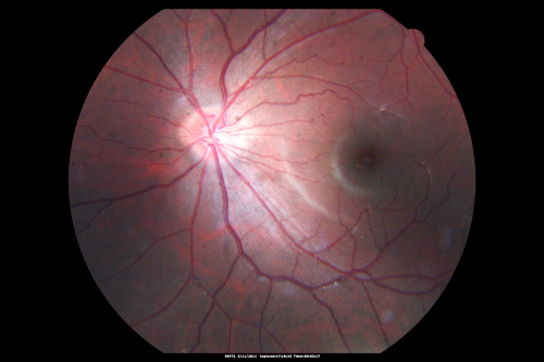 Macular Hemorrahge and Probable CNVM Right eye for 2 weeks VA 20/400 - 20 Year old
20-year-old man noticed vision loss in the right eye about two weeks ago and if anything it seems to be getting worse. He is a high myope.  VISUAL ACUITY:  OD 20/400
