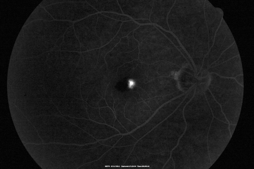 Macular Hemorrahge and Probable CNVM Right eye for 2 weeks VA 20/400 - 20 Year old
20-year-old man noticed vision loss in the right eye about two weeks ago and if anything it seems to be getting worse. He is a high myope.  VISUAL ACUITY:  OD 20/400

