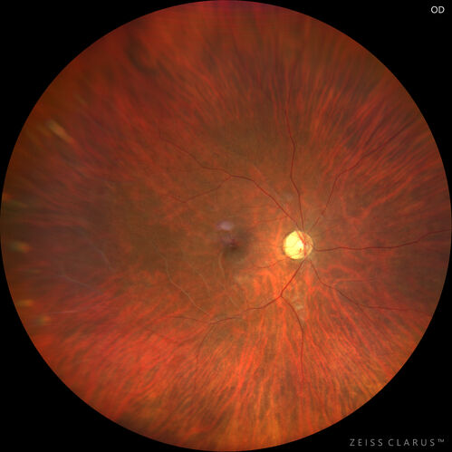 Coats Plus Syndrome - Cerebroretinal microangiopathy with calcifications and cysts (CRMCC)
38 year old female CTC1 positive with Coats Plus Syndrome.  This case was published https://pmc.ncbi.nlm.nih.gov/articles/PMC10649444/
