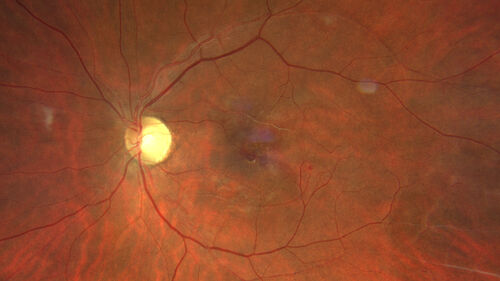Coats Plus Syndrome - Cerebroretinal microangiopathy with calcifications and cysts (CRMCC)
38 year old female CTC1 positive with Coats Plus Syndrome.  This case was published https://pmc.ncbi.nlm.nih.gov/articles/PMC10649444/
