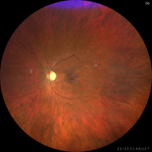 Coats Plus Syndrome - Cerebroretinal microangiopathy with calcifications and cysts (CRMCC)
38 year old female CTC1 positive with Coats Plus Syndrome.  This case was published https://pmc.ncbi.nlm.nih.gov/articles/PMC10649444/
