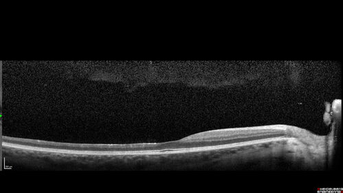 Coats Plus Syndrome - Cerebroretinal microangiopathy with calcifications and cysts (CRMCC)
38 year old female CTC1 positive with Coats Plus Syndrome.  This case was published https://pmc.ncbi.nlm.nih.gov/articles/PMC10649444/
