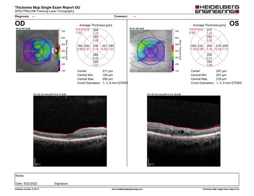 Coats Plus Syndrome - Cerebroretinal microangiopathy with calcifications and cysts (CRMCC)
38 year old female CTC1 positive with Coats Plus Syndrome.  This case was published https://pmc.ncbi.nlm.nih.gov/articles/PMC10649444/
