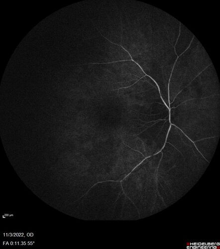 Coats Plus Syndrome - Cerebroretinal microangiopathy with calcifications and cysts (CRMCC)
38 year old female CTC1 positive with Coats Plus Syndrome.  This case was published https://pmc.ncbi.nlm.nih.gov/articles/PMC10649444/
