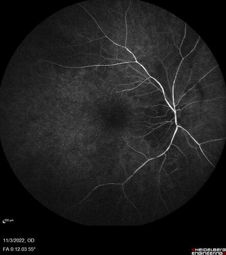 Coats Plus Syndrome - Cerebroretinal microangiopathy with calcifications and cysts (CRMCC)
38 year old female CTC1 positive with Coats Plus Syndrome.  This case was published https://pmc.ncbi.nlm.nih.gov/articles/PMC10649444/
