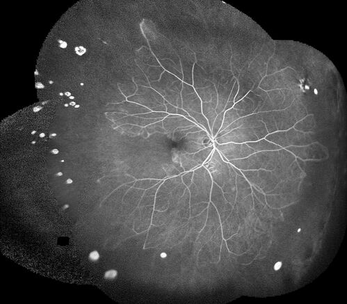 Coats Plus Syndrome - Cerebroretinal microangiopathy with calcifications and cysts (CRMCC)
38 year old female CTC1 positive with Coats Plus Syndrome.  This case was published https://pmc.ncbi.nlm.nih.gov/articles/PMC10649444/
