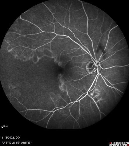 Coats Plus Syndrome - Cerebroretinal microangiopathy with calcifications and cysts (CRMCC)
38 year old female CTC1 positive with Coats Plus Syndrome.  This case was published https://pmc.ncbi.nlm.nih.gov/articles/PMC10649444/

