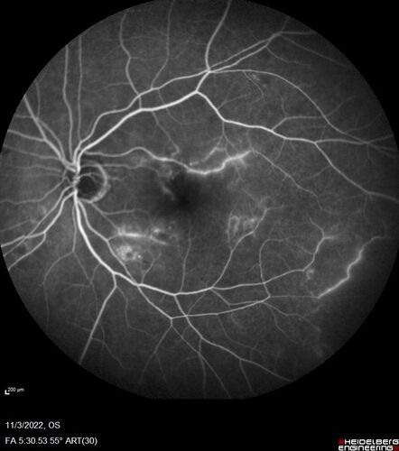 Coats Plus Syndrome - Cerebroretinal microangiopathy with calcifications and cysts (CRMCC)
38 year old female CTC1 positive with Coats Plus Syndrome.  This case was published https://pmc.ncbi.nlm.nih.gov/articles/PMC10649444/
