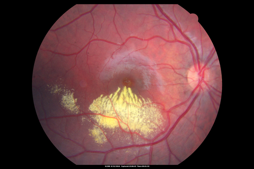 Coats' Disease - 14 year old - Asymptomatic
Presented with macular exudates.  Temporal macroaneurysms responded to laser.  Ultra-wide field FA shows nonperfusion
