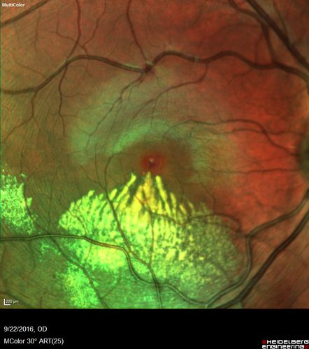 Coats' Disease - 14 year old - Asymptomatic
Presented with macular exudates.  Temporal macroaneurysms responded to laser.  Ultra-wide field FA shows nonperfusion

