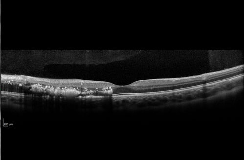 Coats' Disease - 14 year old - Asymptomatic
Presented with macular exudates.  Temporal macroaneurysms responded to laser.  Ultra-wide field FA shows nonperfusion

