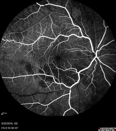 Coats' Disease - 14 year old - Asymptomatic
Presented with macular exudates.  Temporal macroaneurysms responded to laser.  Ultra-wide field FA shows nonperfusion
