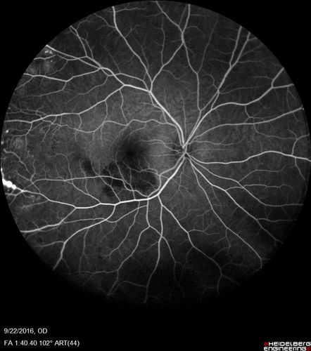 Coats' Disease - 14 year old - Asymptomatic
Presented with macular exudates.  Temporal macroaneurysms responded to laser.  Ultra-wide field FA shows nonperfusion
