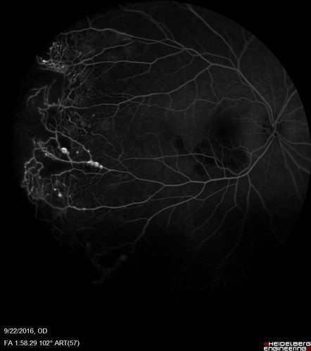 Coats' Disease - 14 year old - Asymptomatic
Presented with macular exudates.  Temporal macroaneurysms responded to laser.  Ultra-wide field FA shows nonperfusion
