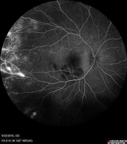 Coats' Disease - 14 year old - Asymptomatic
Presented with macular exudates.  Temporal macroaneurysms responded to laser.  Ultra-wide field FA shows nonperfusion
