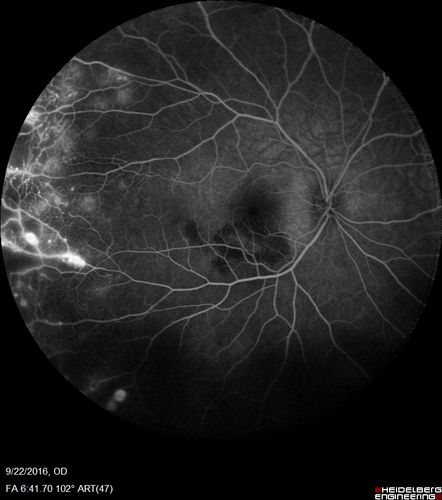 Coats' Disease - 14 year old - Asymptomatic
Presented with macular exudates.  Temporal macroaneurysms responded to laser.  Ultra-wide field FA shows nonperfusion
