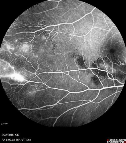 Coats' Disease - 14 year old - Asymptomatic
Presented with macular exudates.  Temporal macroaneurysms responded to laser.  Ultra-wide field FA shows nonperfusion
