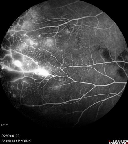 Coats' Disease - 14 year old - Asymptomatic
Presented with macular exudates.  Temporal macroaneurysms responded to laser.  Ultra-wide field FA shows nonperfusion
