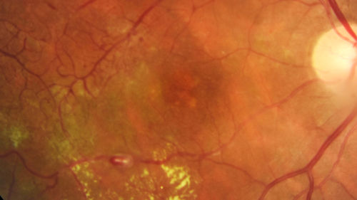 Macular Macroaneurysm with Coats Disease
61 year old man with increased leakage from macular macroaneurysm right eye
