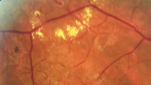Macular Macroaneurysm with Coats Disease
61 year old man with increased leakage from macular macroaneurysm right eye
