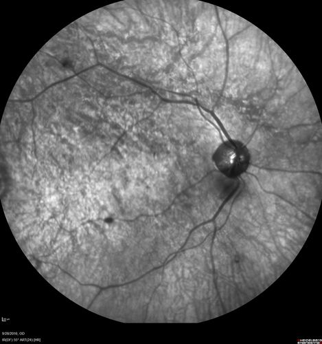 Macular Macroaneurysm with Coats Disease
61 year old man with increased leakage from macular macroaneurysm right eye
