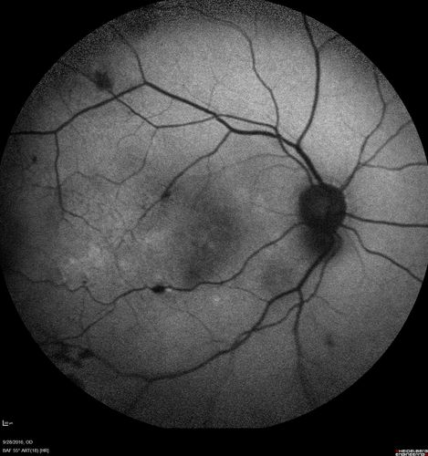 Macular Macroaneurysm with Coats Disease
61 year old man with increased leakage from macular macroaneurysm right eye
