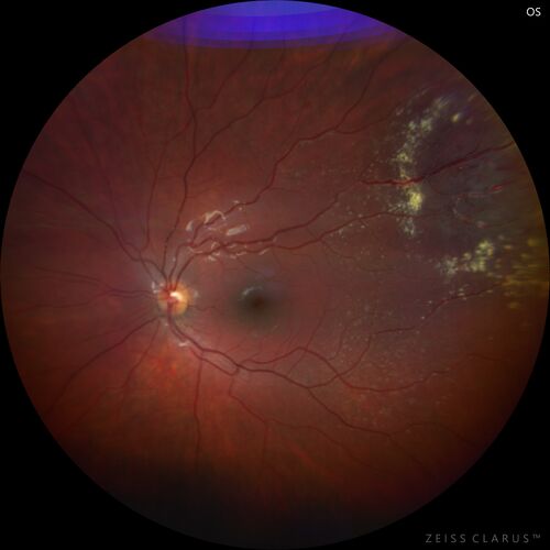 Coats' Disease - 8-year-old boy - Asymptomatic
Normal vision - Lesion picked up on examination

