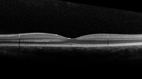 Coats' Disease - 8-year-old boy - Asymptomatic
Normal vision - Lesion picked up on examination
