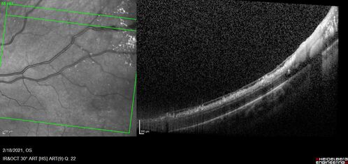 Coats' Disease - 8-year-old boy - Asymptomatic
Normal vision - Lesion picked up on examination
