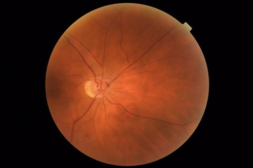 Coats Disease - Parafoveal Telangiectasis Type I - Right Eye
67 year old man with long history of vision loss in the right eye.  Previously treated with laser, avastin.  VA 20/200.
