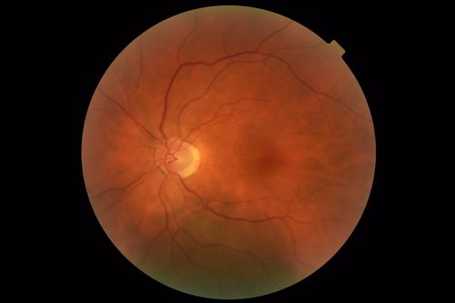 Coats Disease - Parafoveal Telangiectasis Type I - Right Eye
67 year old man with long history of vision loss in the right eye.  Previously treated with laser, avastin.  VA 20/200.
